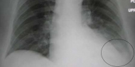Portugal é segundo país da Europa com maior taxa de mortalidade por pneumonia